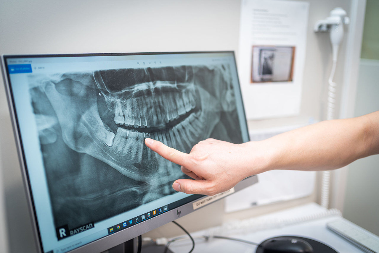 Wisdom Teeth & Extractions
